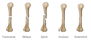 a01 골절 기본 개념