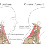 [doctormodu]1 chronic forward head posture