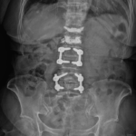 [doctormodu]1 screw loosening AP