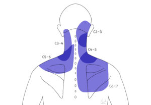 07 경추축성통증(Axial pain)