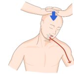 [doctormodu]3 spurling test