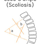 [doctormodu]4 cobbs angle