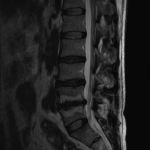 [doctormodu]4 modic change MRI