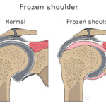 [doctormodu]01 frozen shoulder 병태생리