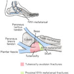[doctormodu]1 metatarsal bone fracture