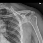[doctormodu]1 GH arthritis