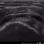 [doctormodu]1 SASD bursitis