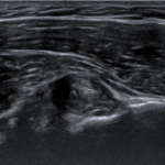[doctormodu]1 biceps tendinitis US