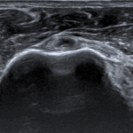 [doctormodu]1 biceps tendon tear - horizontal view