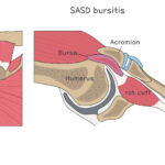 [doctormodu]1 impinge bursitis tear