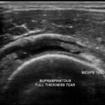 [doctormodu]1 rotator cuff tear