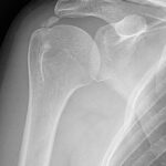 [doctormodu]2 Calcific tendinitis