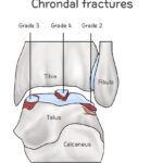 [doctormodu]6 Osteochondral Fracture of the Talus