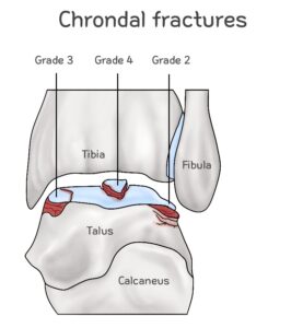 d05 거골골절 talus fracture