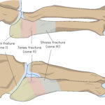 [doctormodu]1 5th metatarsal bone fracture classification