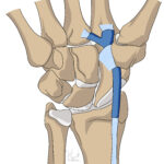 [doctormodu]1 FCR insertion