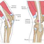 [doctormodu]1 IT band gerdy tubercle patho