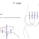 [doctormodu]1 J sign patella grinding test PGT physical