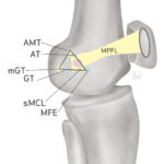 [doctormodu]1 MPFL loosening patho