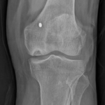 [doctormodu]1 SONK X-ray