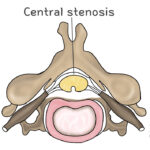 [doctormodu]1 spinal canal stenosis types