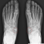 [doctormodu]1 accessory navicular bone x-ray