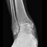 [doctormodu]1 ankle OA X-ray