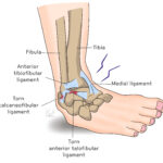 [doctormodu]1 ankle sprain patho
