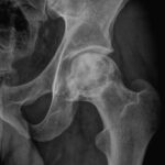 [doctormodu]1 avascular necrosis of femoral
