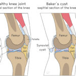 [doctormodu]1 baker cyst patho