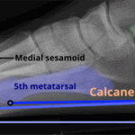 [doctormodu]1 calcaneal pitch angle