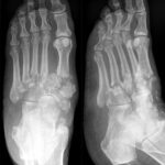 [doctormodu]1 charcot foot x-ray