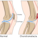 [doctormodu]1 chondromalacia patho