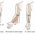 [doctormodu]1 cubitus varus-carrying angle 측정법