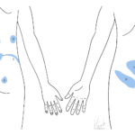 [doctormodu]1 discogenic low back pain dermatome