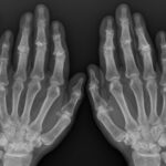 [doctormodu]1 hand OA
