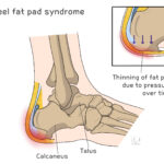 [doctormodu]1 heel fat pad syndrome
