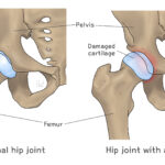 [doctormodu]1 hip OA