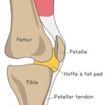 [doctormodu]1 hoffas fat pad syndrome patho
