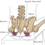 [doctormodu]1 ischial bursitis patho