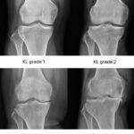 [doctormodu]1 knee OA KL grade stage X-ray