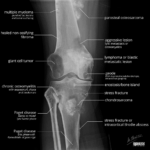 [doctormodu]1 knee bone lesions