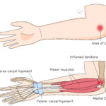 [doctormodu]1 medial epicondylitis