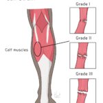 [doctormodu]1 medial gastrocnemius strain
