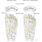 [doctormodu]1 morton's neuroma