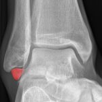 [doctormodu]1 os subfibularae