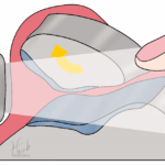 [doctormodu]1 patella dislocation US