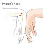 [doctormodu]1 phalen test calpal tunnel