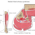 [doctormodu]1 shin splint patho