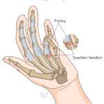 [doctormodu]1 trigger finger patho